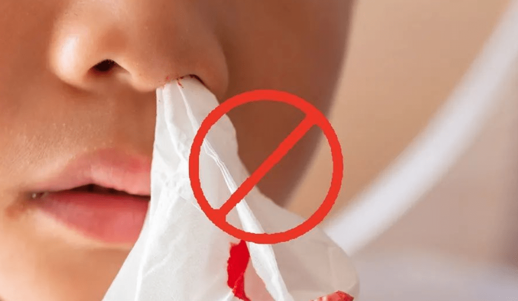 健康小常识之流鼻血该怎么处理?_方法_纸巾_原因