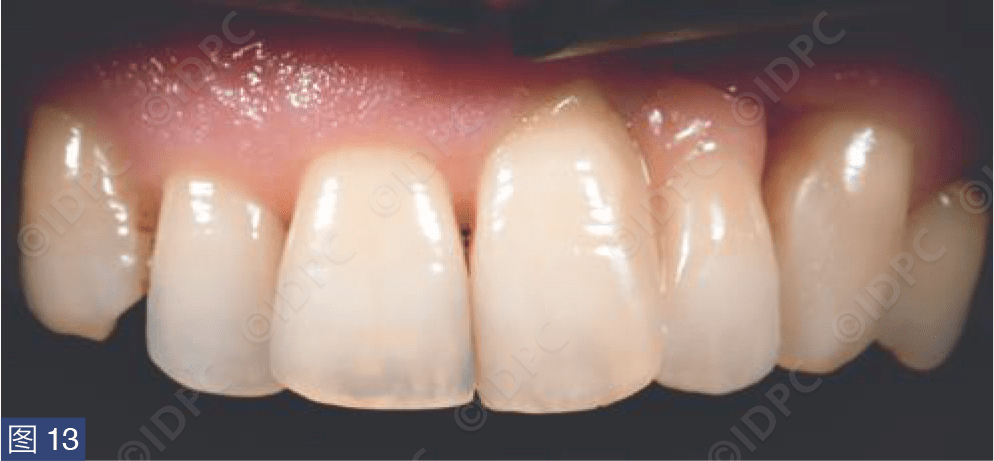 【精选案例】利用数字印模制作单翼粘接桥——口内扫描仪trios 3使用