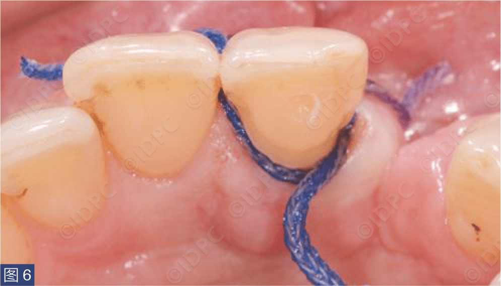为了采集数字印模使用双线排龈技术.