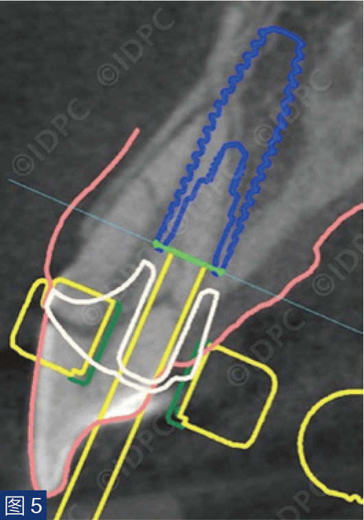 【精选案例】CAD/CAM愈合基台及美学区引导手术实现软组织轮廓保存：病例报告（美）_种植_牙龈