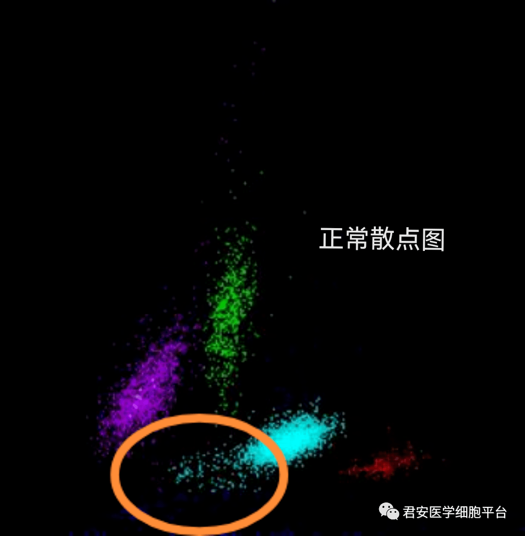 通道下出现杂乱的红色散点,网织红散点图高荧光区拖尾现象明显plt减低