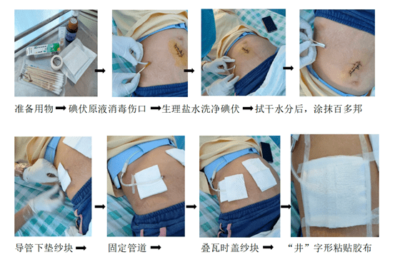 【聚焦临床】腹膜透析导管破裂,脱落了怎么办?