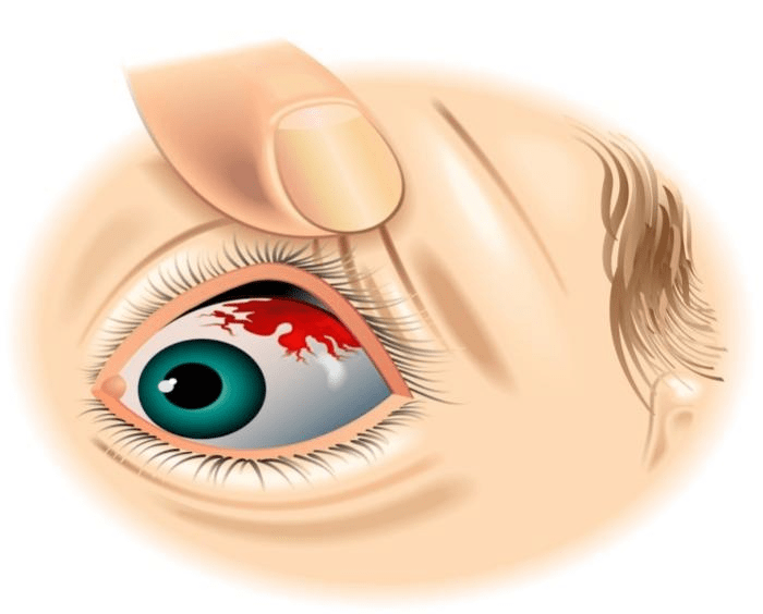 结膜下出血是什么我们从肉眼可以看到眼睛表面分为黑眼珠和白眼球