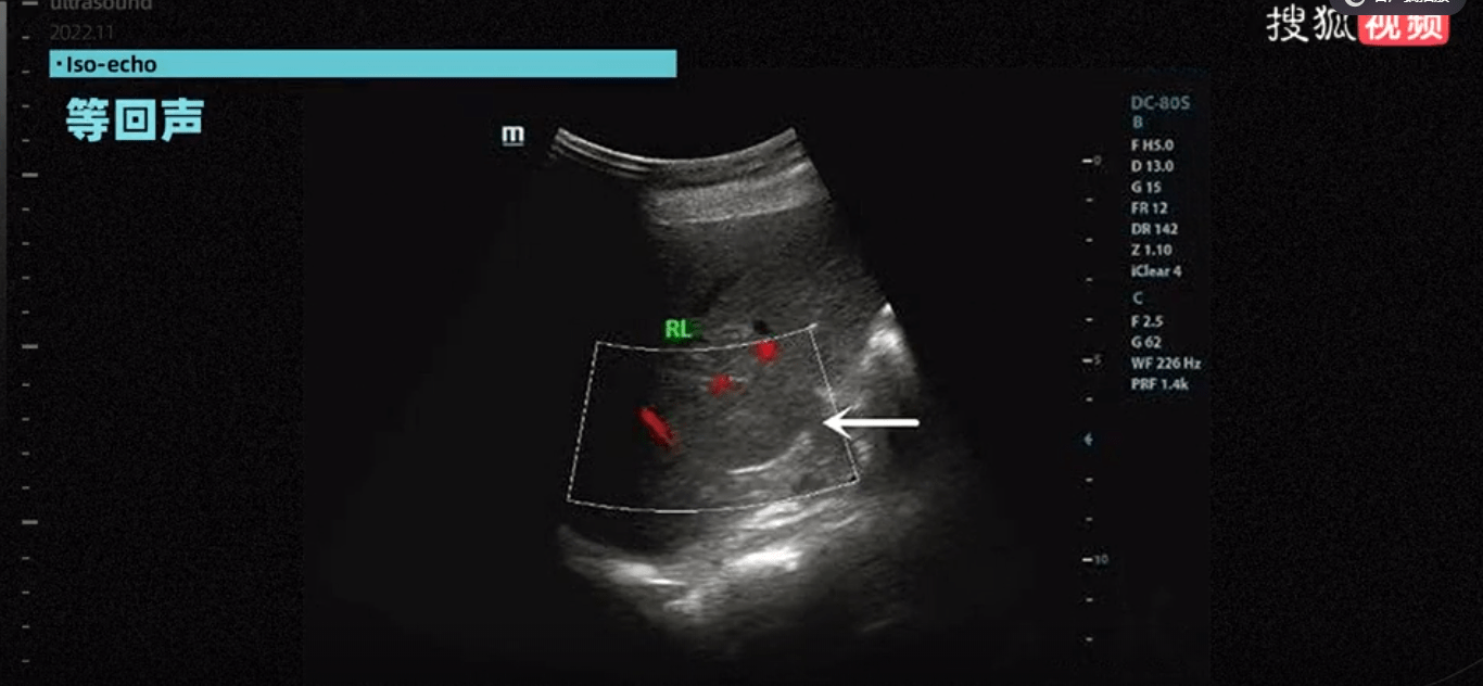 b超"回声"大揭秘:胆结石是怎么被发现的?_超声_图像_反射