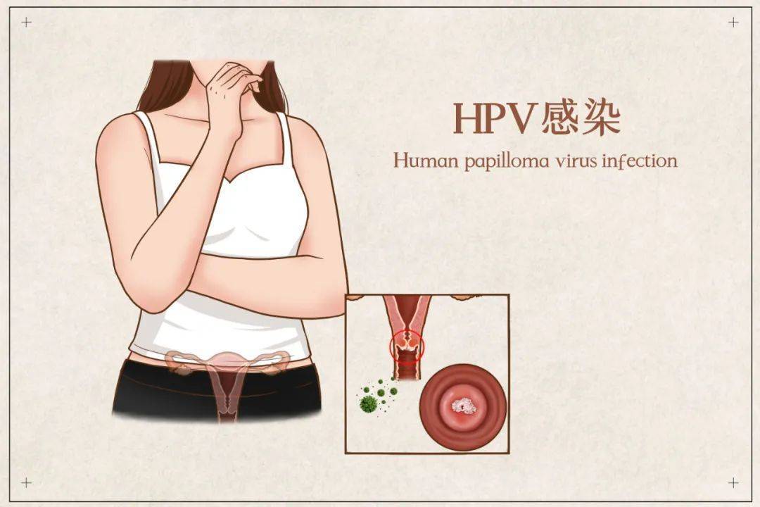 外阴感染hpv的症状图片