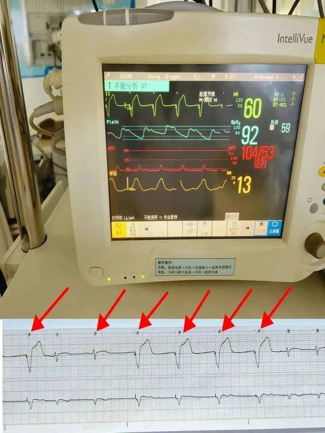 小身材 大作为——特色医学中心成功完成首例无导线起搏器植入术