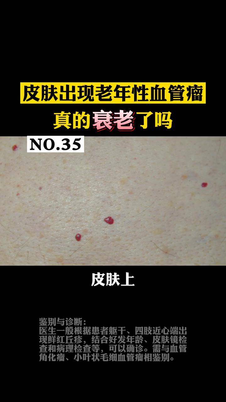 皮肤上突然出现一个凸起的小红点 老年性血管瘤 真的是衰老的表现吗?
