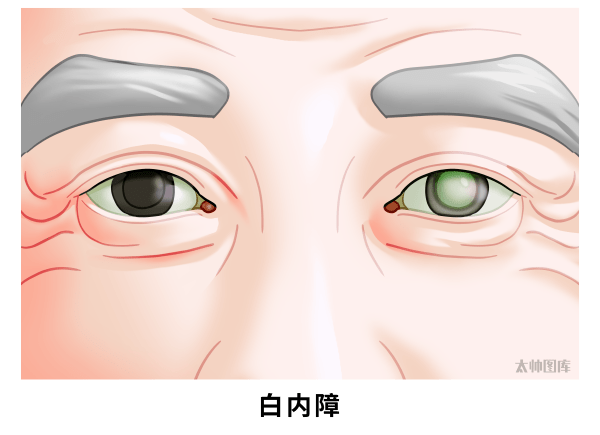 症状_眼睛_患者