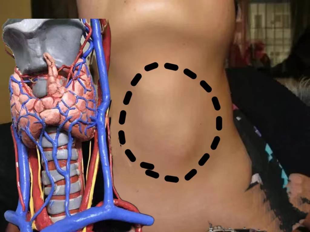 嗓子肿痛脖子粗大?过来人分享最佳自愈经验,亲测有效!