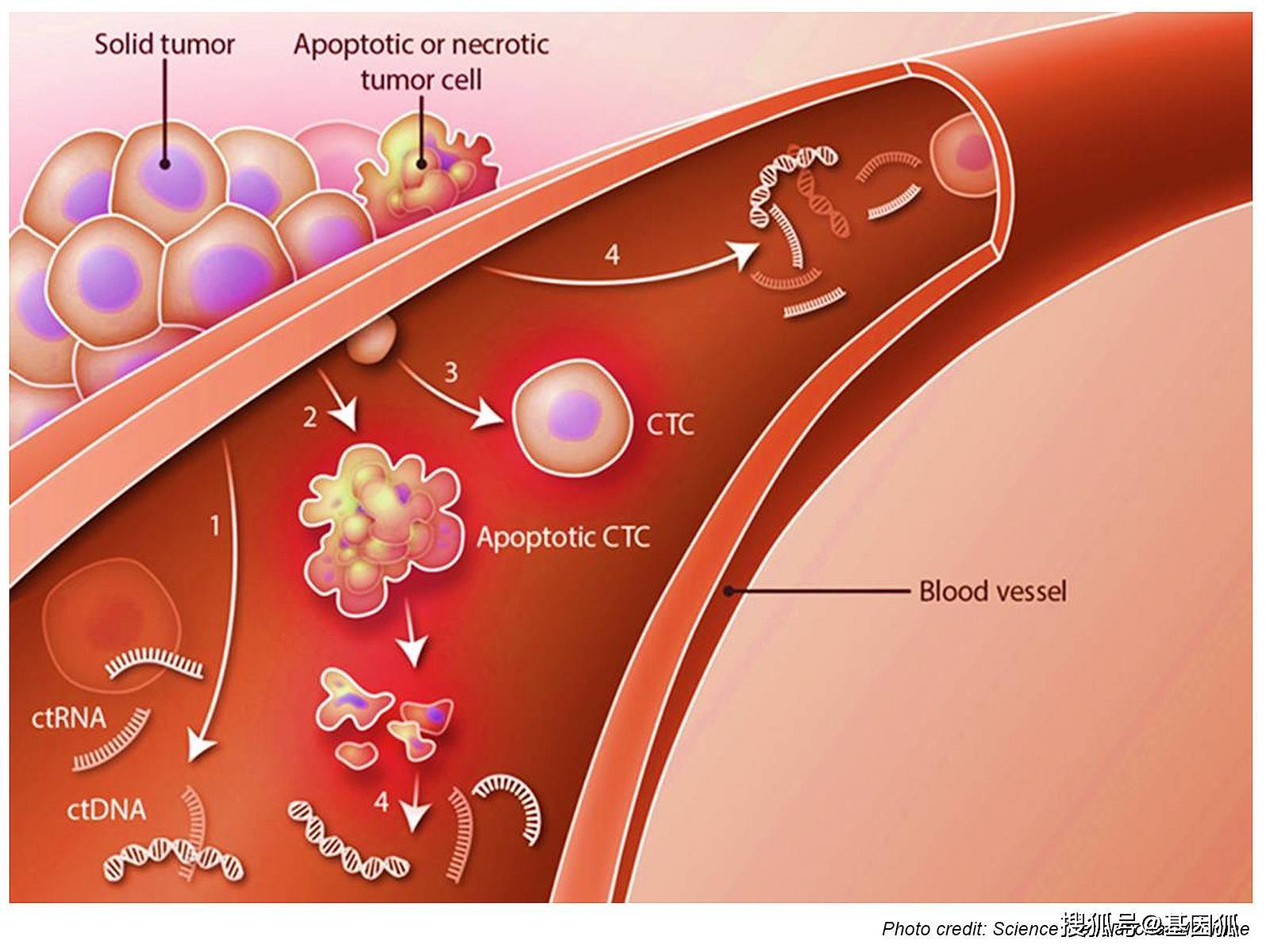 经验分享:循环肿瘤细胞在转移性乳腺癌中的应用_治疗_患者_临床