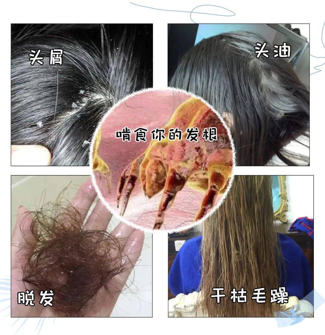脱发头油都是因为它