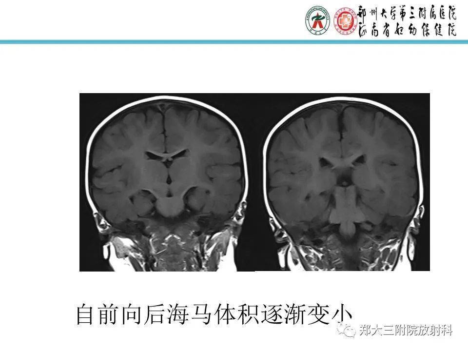 海马硬化的影像诊断_全网_解剖图_系统