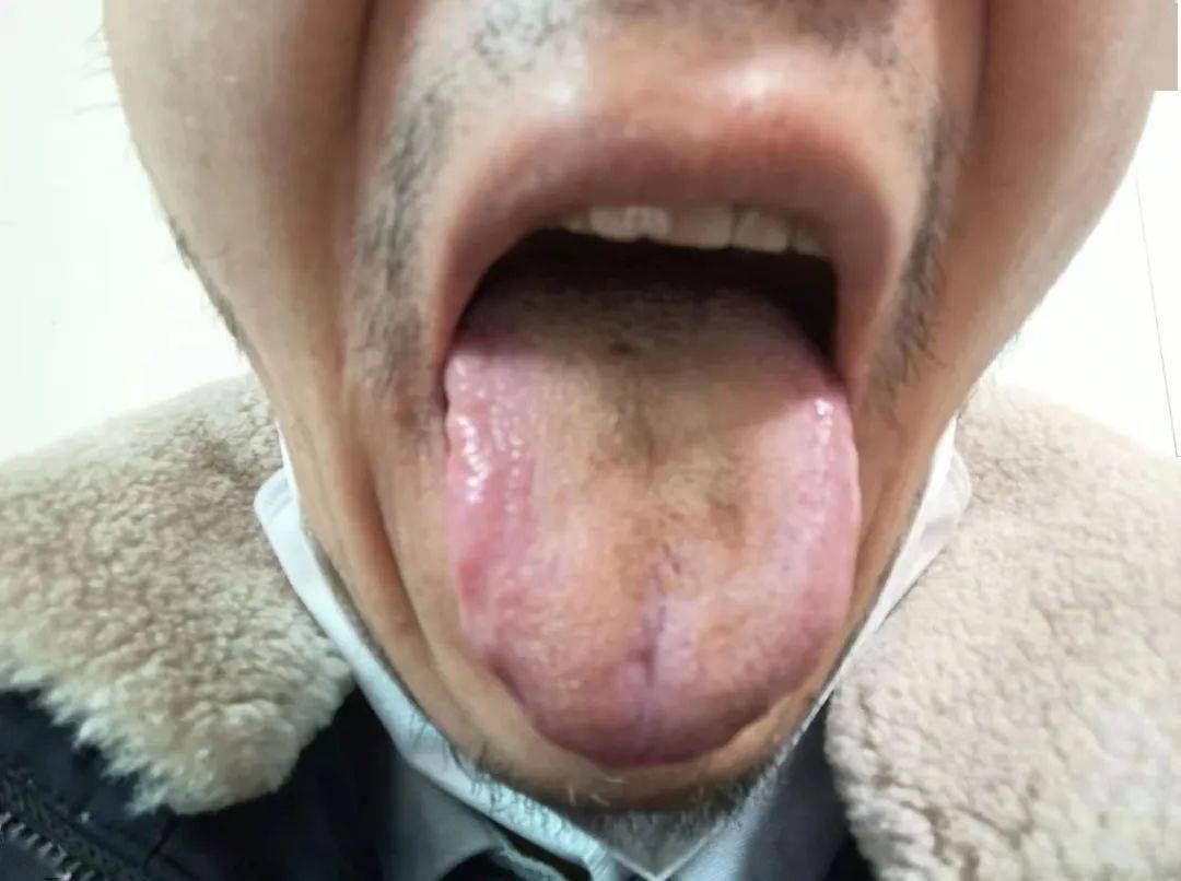 医案分享 | 慢性咽炎舌苔发黑,脐灸膏方养阴清热_治疗_诊断_患者