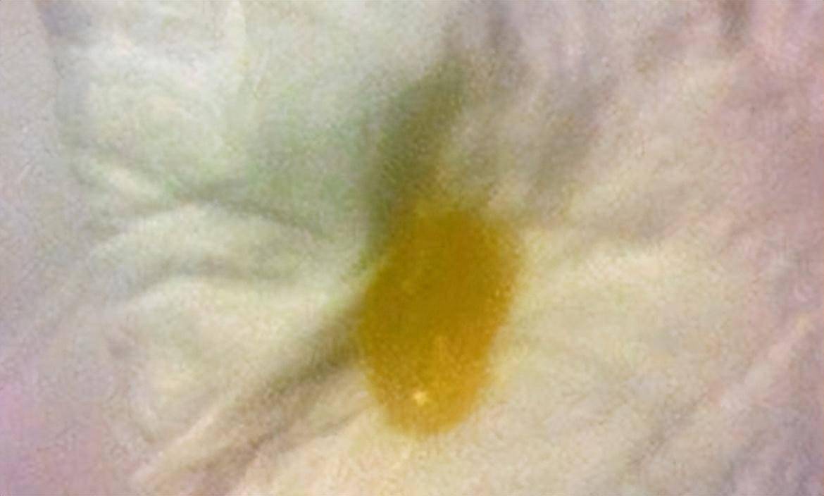黄痰是什么原因 来自搜狐网