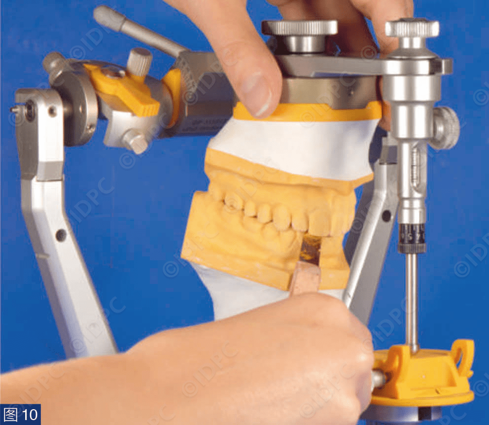 【精选案例】学系列 | 分析与咬合重建中的颌架应用