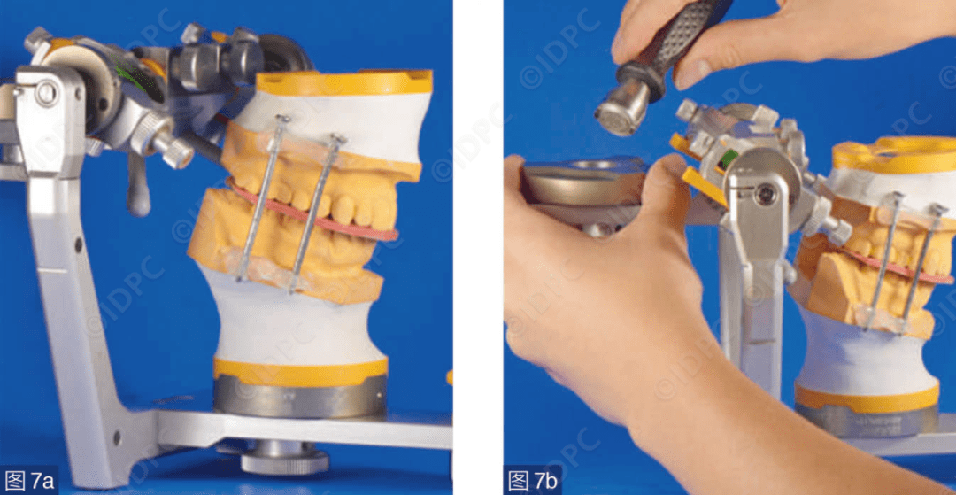 【精选案例】学系列 | 分析与咬合重建中的颌架应用(德)_检查_测试