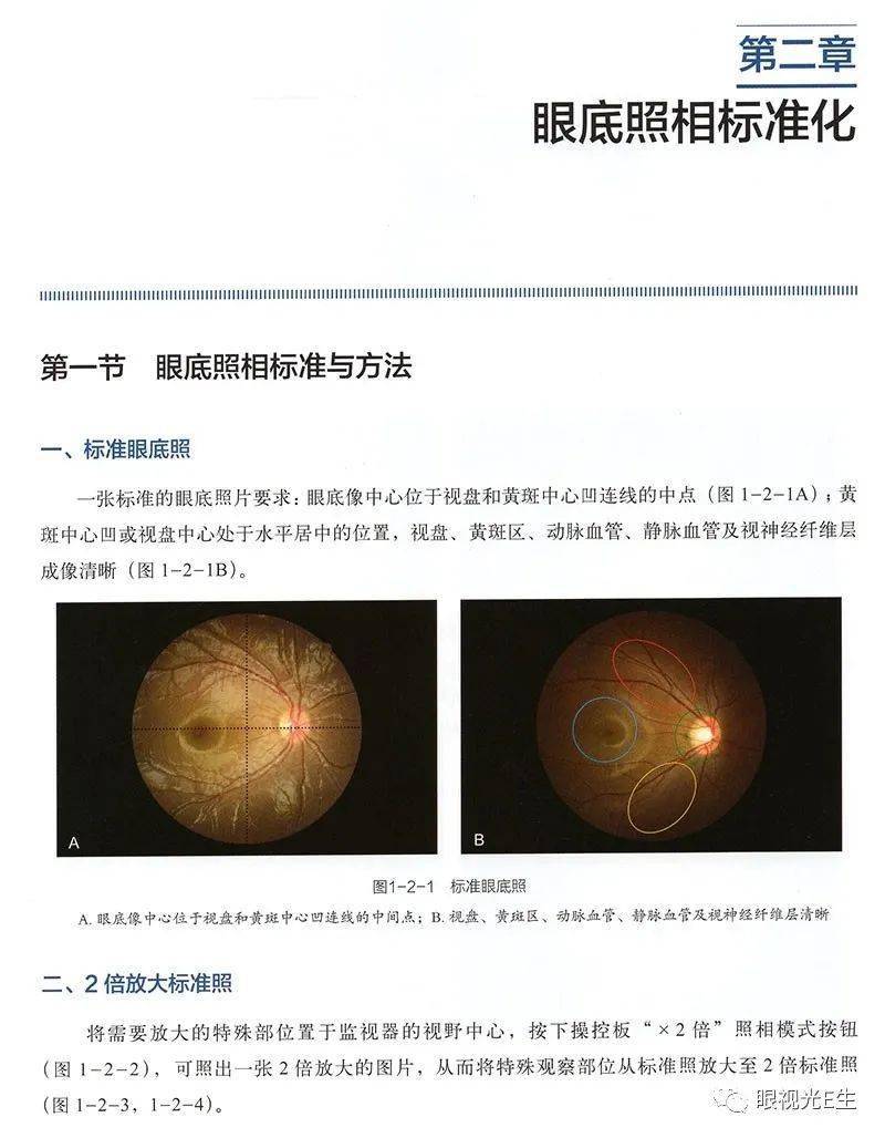 眼底照相正常图片解读图片