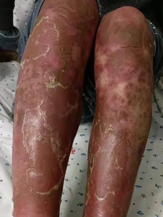 我院皮肤科成功医治一例重症红皮病型银屑病_患者_治疗_李先生