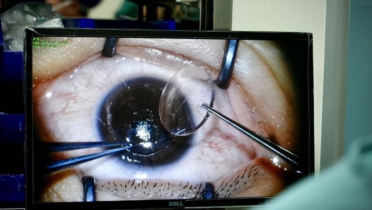 全新人工合成角膜移植,有望缓解供体紧缺_小琦_张明昌_患者
