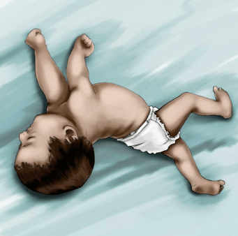 有些宝宝甚至出现角弓反张(即头和身体持续后仰,如下图),或者左右两只