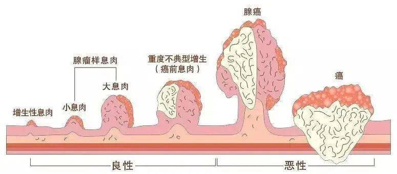 胃息肉的病理类型有胃底腺息肉,增生性息肉,腺瘤性息肉,炎性息肉以及