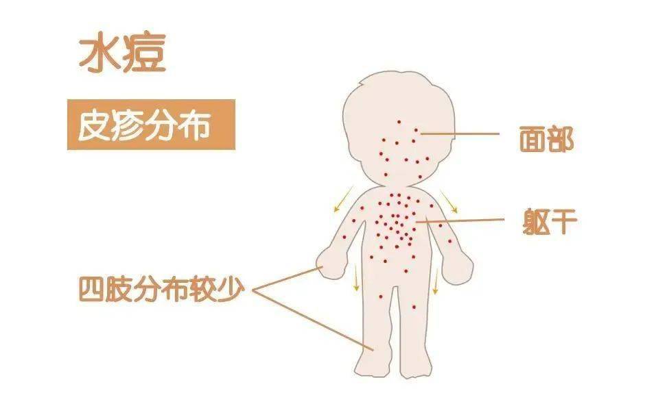 水痘的主要传播途径图片