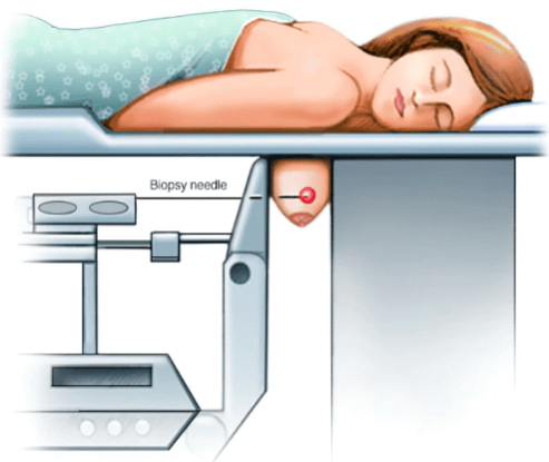 新华医院影像导航乳腺穿刺术实现乳腺疾病的精确诊断和治疗_定位