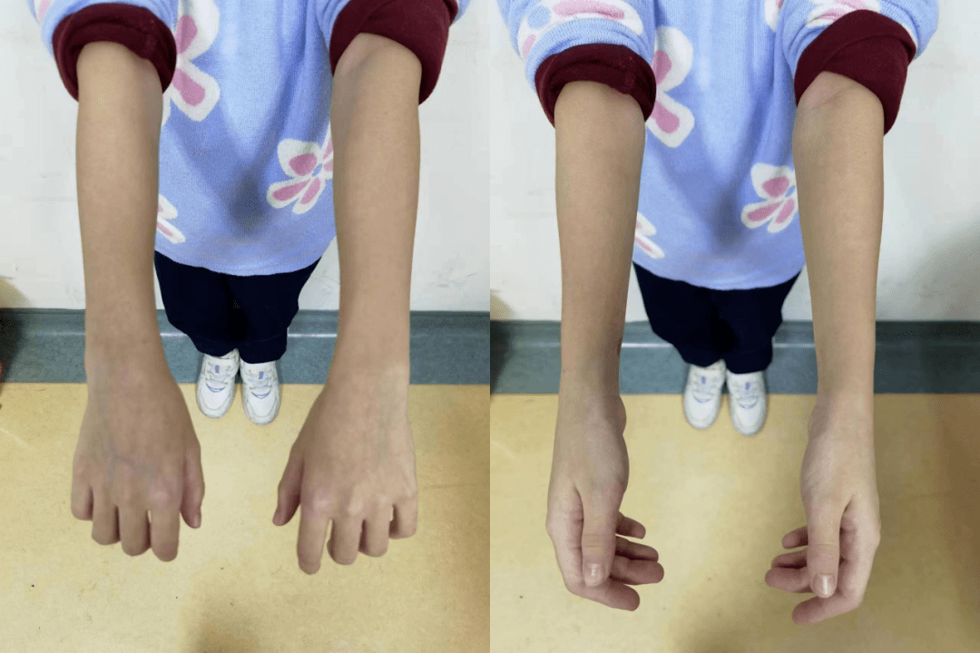 儿童骨折塑形能力图图片