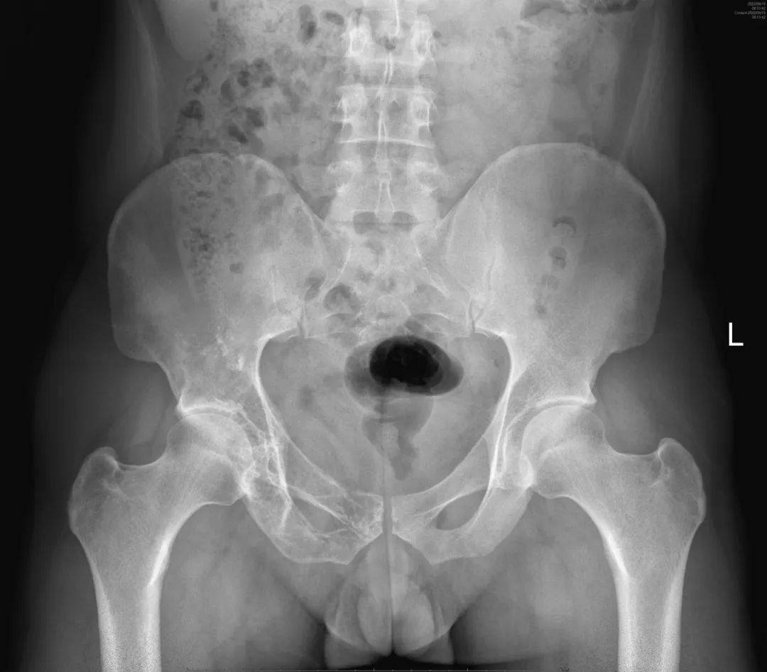 臀部骨盆光芒x 库存例证. 插画 包括有 臀部, 光芒, 权利, 骨盆, 显示, 破裂 - 4731652