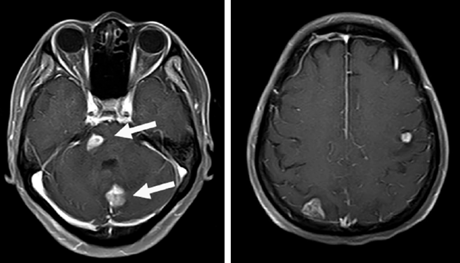 症狀,出現左上肢麻木,腦水腫,腦 mri 顯示疾病進展,左額葉新發病灶,原