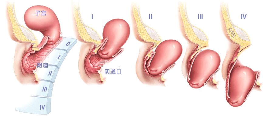 较严重者,会感到阴道口常有"异物"掉出,伴有不同程度的垂坠感,腰部