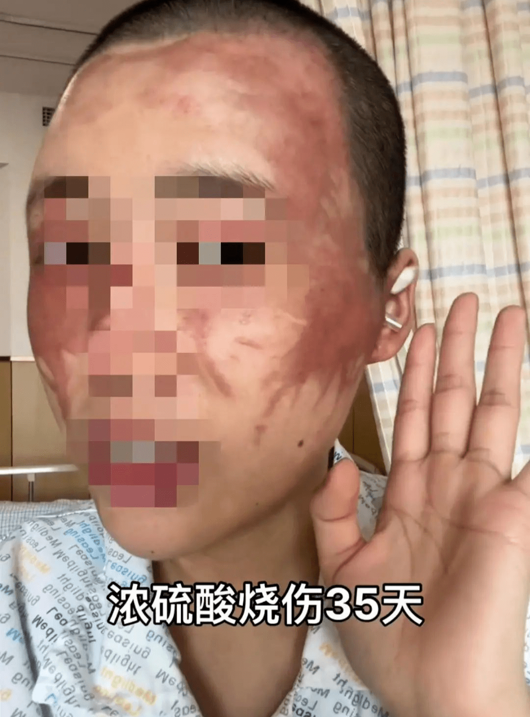 哎!妻子不愿生二胎,浙江男子持刀威胁,泼硫酸,致其毁容