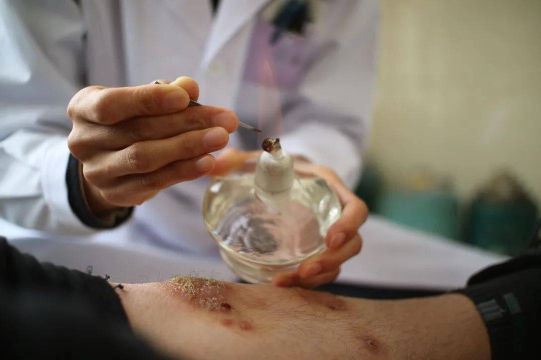 中医院的这位"容嬷嬷",众人直呼扎的好!_治疗_患者_皮肤