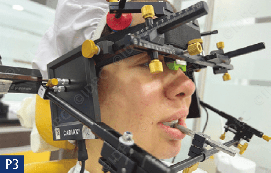 herbst矫治器的数字化设计与临床应用(德)作者:bj02rn ludwig 博士