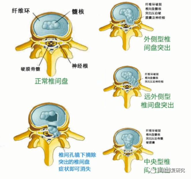 l4l5椎间盘膨出图片