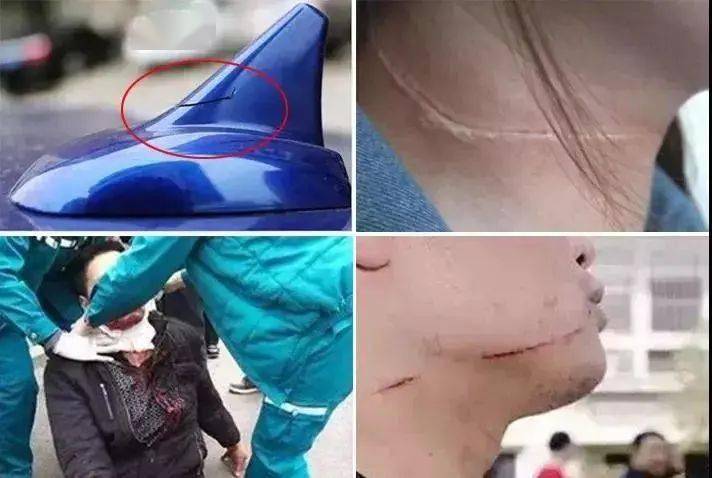 导致孩子的后颈被割伤划到了孩子脖子上不料一根风筝线在公园玩耍一对