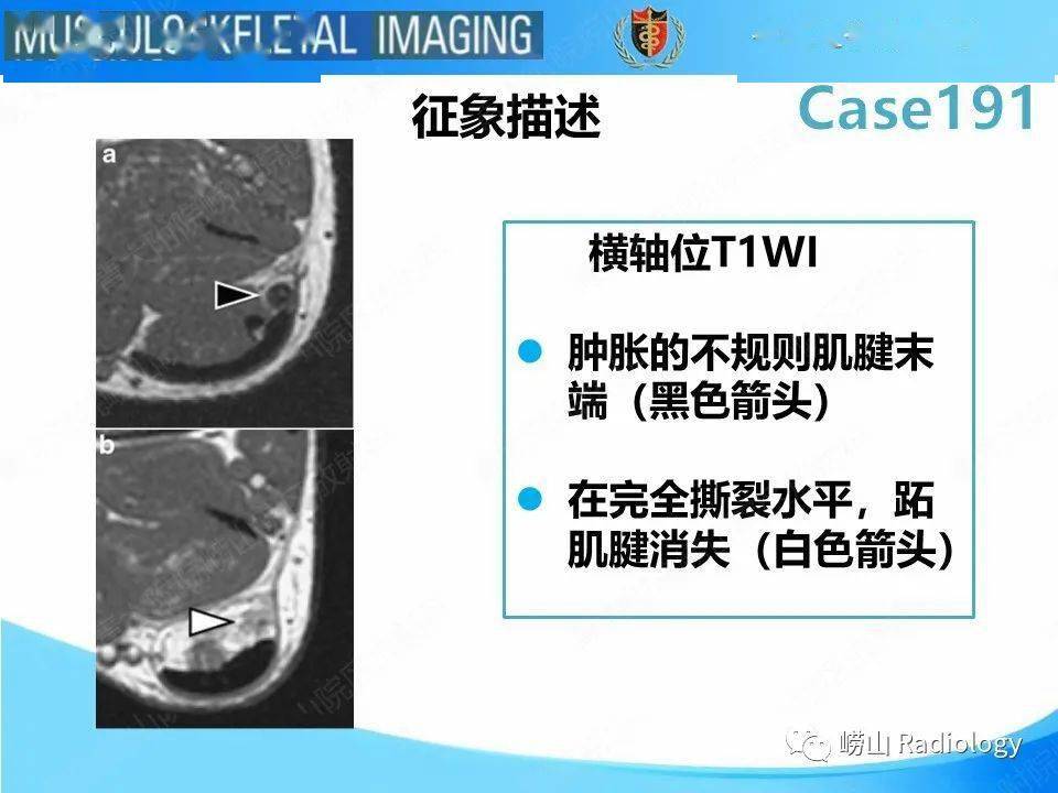 跖肌腱超声图片