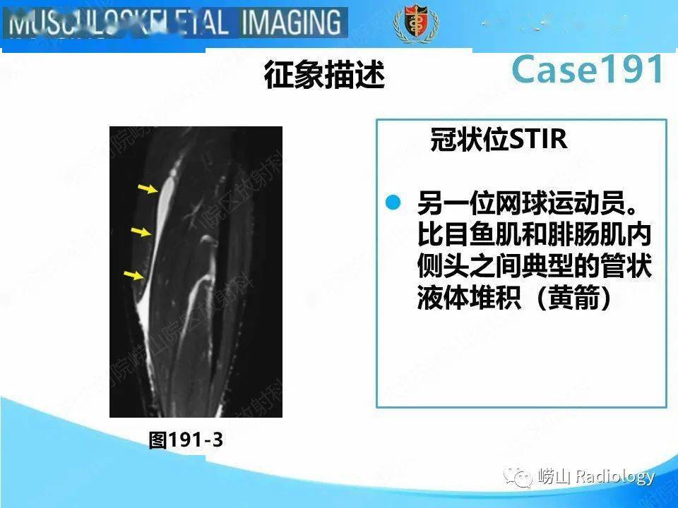 跖肌腱超声图片