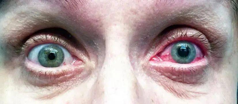 【世界青光眼日】守护眼健康,警惕"视力小偷"!_治疗_视神经_发病