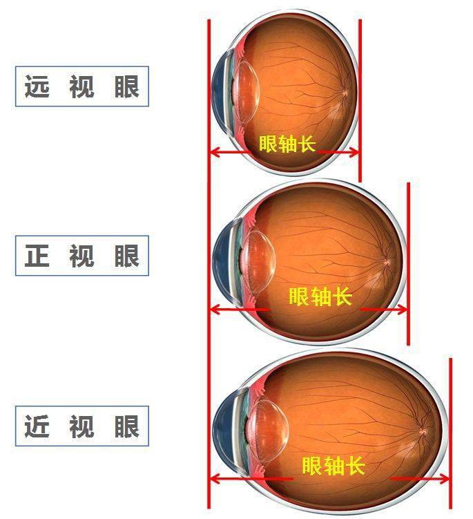 远视眼可以恢复吗图片