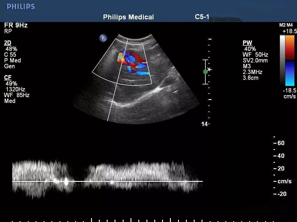 超聲典型病例:門靜脈-肝靜脈瘻_血流_患者_回聲