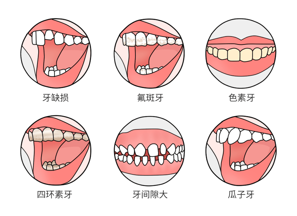 适用于氟斑牙