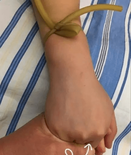 学会这 4 个方法,提升穿刺成功率!_血管_静脉_针头