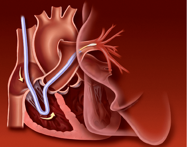 右心导管检查术02异常左心导管图形-限制性心肌病:通过侵入性血流动力