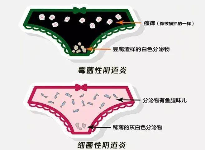 可能为子宫颈炎;分泌物呈豆腐渣样或凝乳块状:可能有霉菌性阴道炎