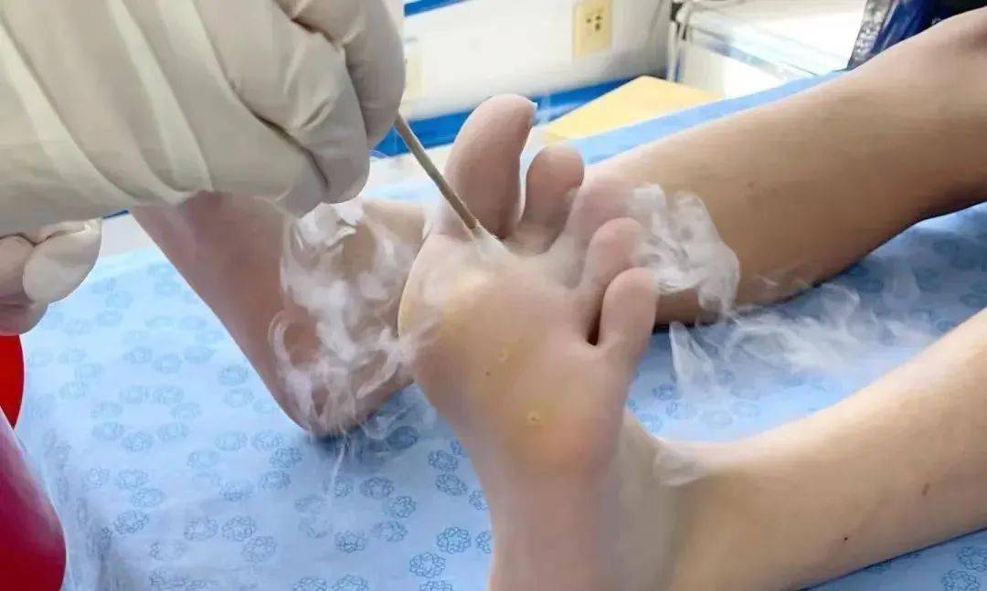 泾县中医院液氮冷冻治疗帮你忙…_局部_门诊病人_组织