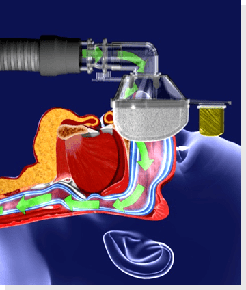 世界睡眠日 | 睡眠打鼾可以用呼吸机治疗?
