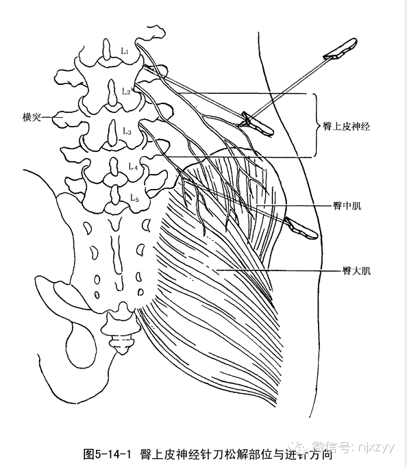 臀上皮神经体表定位图图片
