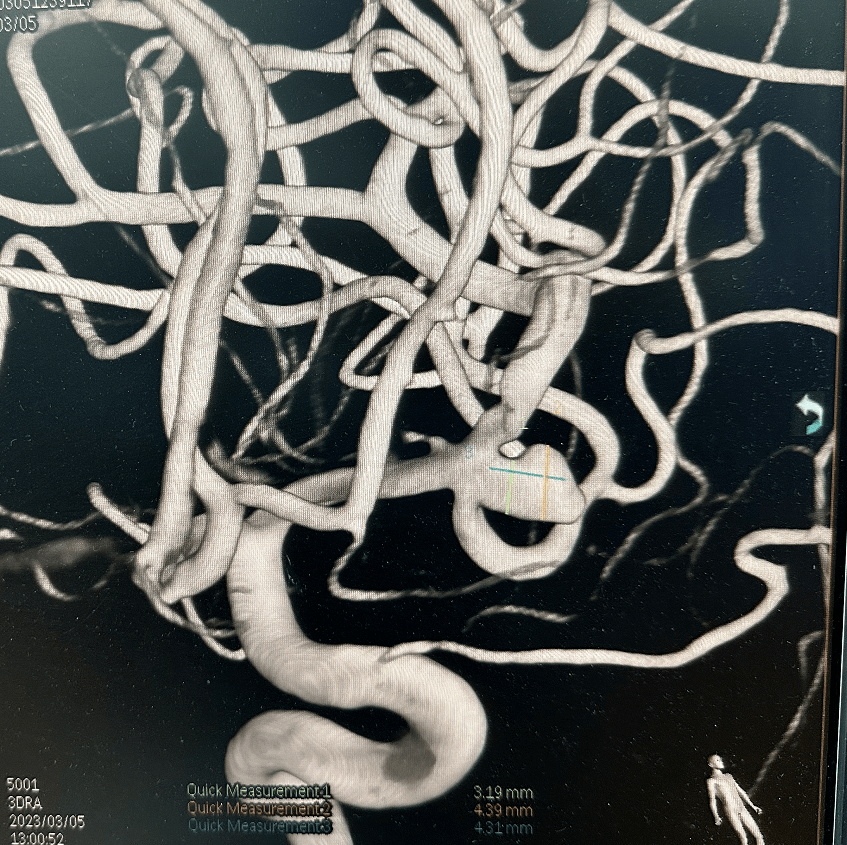 one and done,一网无余丨王云彦教授:应用web瘤内扰流装置治疗大脑中