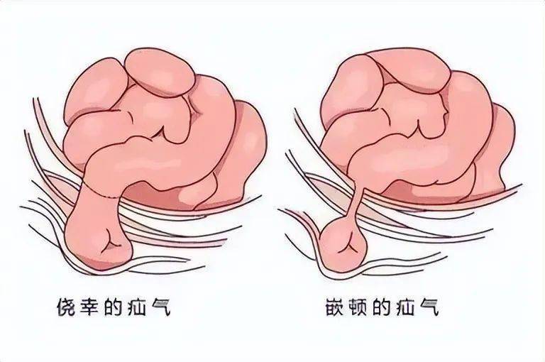 婴儿疝气图片图解图片